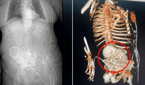 Brasil - Feto calcificado