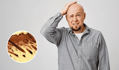 Científicos de EE.UU. descubren la molécula PP405, relacionada con la pérdida de pelo.