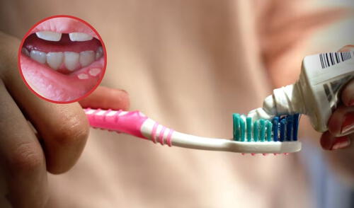 ¿Qué causa el fluoruro de estaño? El compuesto presente en 14 pastas dentales en Perú que el Digemind alertó como riesgoso l compuesto presente en 14 pastas dentales en Perú que el Digemind alertó como riesgoso