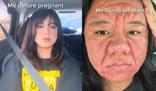 La joven de 28 años sufrió acné gestacional, por lo que, su rostro cambio bastante.