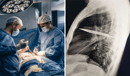 Hombre fue intervenido en un hospital para extraerle un cuchillo que llevaba 8 años dentro de su pecho.