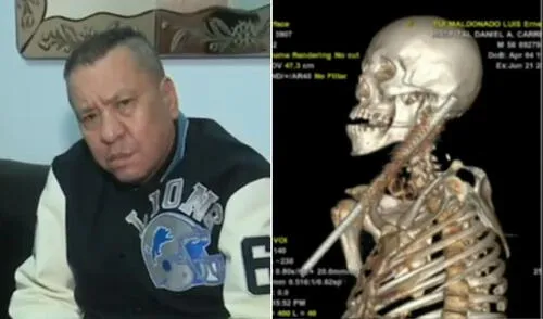 Hombre sobrevive milagrosamente tras caer sobre una reja de fierro en Magdalena del Mar