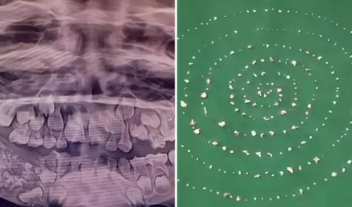 Un niño en India sorprendió al mundo tras serle extraídos 526 dientes, estableciendo un nuevo récord mundial en odontología