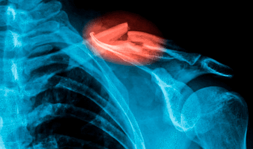 Científicos desarrollan una 'pistola de pegamento' 3D para imprimir injertos óseos y reparar fracturas en cirugías