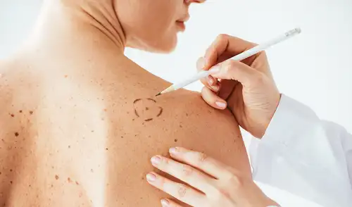 El melanoma representa aproximadamente el 5% de los cánceres de piel y puede ser muy agresivo. Foto: Quironsalud