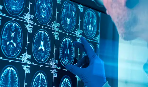 Los hallazgos ayudarían a entender los factores que influyen en los trastornos mentales que suelen aparecer en la adolescencia. Foto: IStock Los hallazgos ayudarían a entender los factores que influyen en los trastornos mentales que suelen aparecer en la adolescencia. Foto: IStock