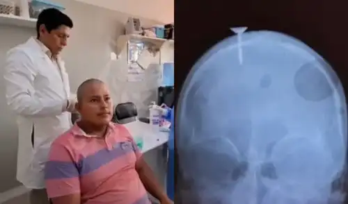 Un obrero de 24 años sobrevivió tras un accidente laboral en Loreto, donde un clavo se incrustó en su cráneo. Fue salvado tras una compleja cirugía en el Hospital Regional.