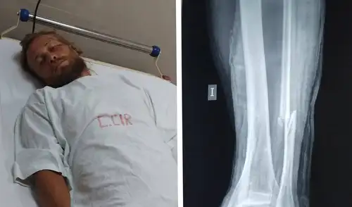 El turista ruso estuvo internado en el hospital de Áncash tras ser atropellado.