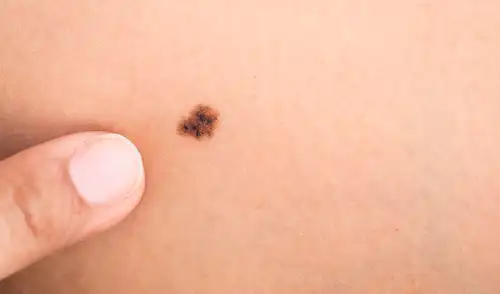 Más del 50% de los casos de melanoma son detectados en fases avanzadas. Foto: Vibrant Dermatology