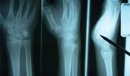 Estos hallazgos plantean nuevas oportunidades para tratamientos que optimicen la recuperación de fracturas, especialmente en pacientes con riesgo de complicaciones durante su cicatrización.