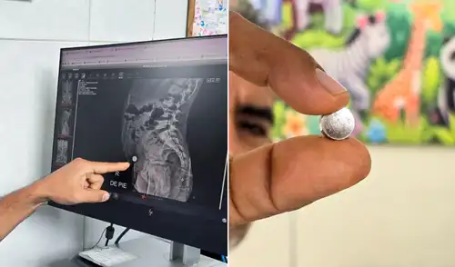 Menor de 6 años se salva tras extraer pila de reloj de su intestino Menor de 6 años se salva tras extraer pila de reloj de su intestino