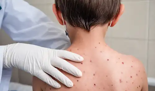 Los pacientes detectados con el mal ya son atendidos por especialistas.