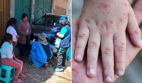 Puno enfrenta una alerta sanitaria debido al incremento de casos de sarampión, que pasaron de 2 a 8 en tres días. El Ministerio de Salud implementa brigadas de vacunación para frenar el brote.