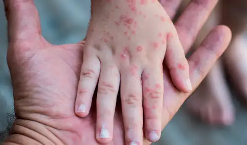 Especialistas advierten que el virus se propaga principalmente en niños