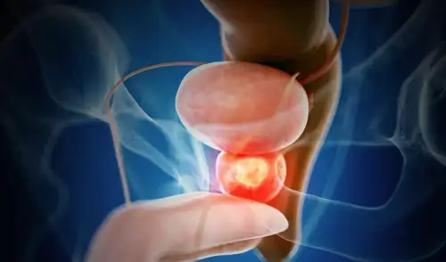 Un ensayo clínico internacional demuestra que una terapia combinada con enzalutamida y talazoparib frena la progresión del cáncer de próstata avanzado.