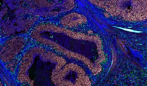 Melanoma con gran aumento donde macrófagos se encuentran frente a células cancerosas, listos para atacarlas. Foto: Laboratorio Phan / Instituto Garvan