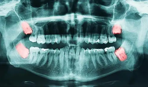 Un experimento con dientes de ratón revela cómo se determina el tamaño de los molares durante el desarrollo.