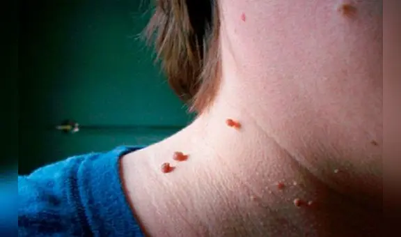 ¿Qué son y cómo quitar los lunares de carne o acrocordones?