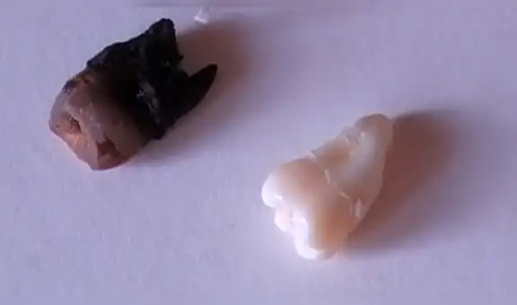 Así quedó un diente sano, luego de haber estado 24 horas sumergido en Coca Cola [FOTOS]