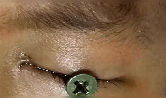 Cortaba césped y la máquina hizo volar un tornillo que se clavó en el ojo de su hijo