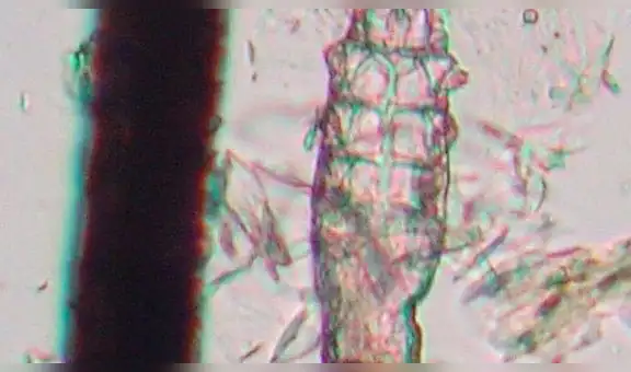 Demodex:  el ácaro que vive y se reproduce en el rostro ¿es una amenaza?