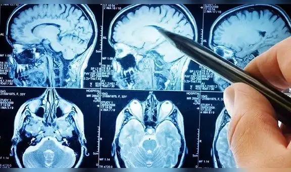 Algunos pacientes con coronavirus mostraron signos de lesiones cerebrales