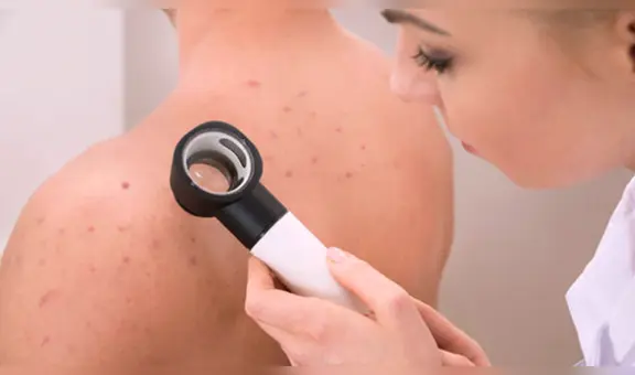 Manchas negras:¿Qué son y cómo curar sus apariciones en el cuello y axilas?