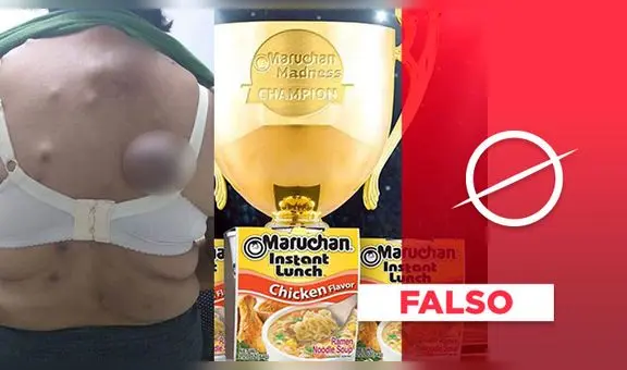 Los tumores de la foto viral no fueron causados por tomar sopa instantánea