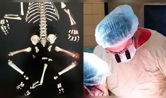 Médicos salvan la vida de un bebé que nació con tres piernas, dos genitales y sin ano [FOTOS]