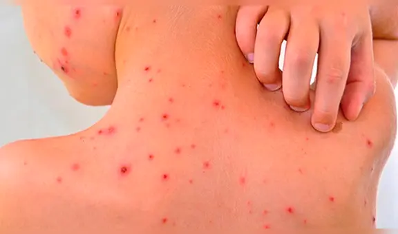 México: aumentan los casos de fiebre manchada [FOTOS]