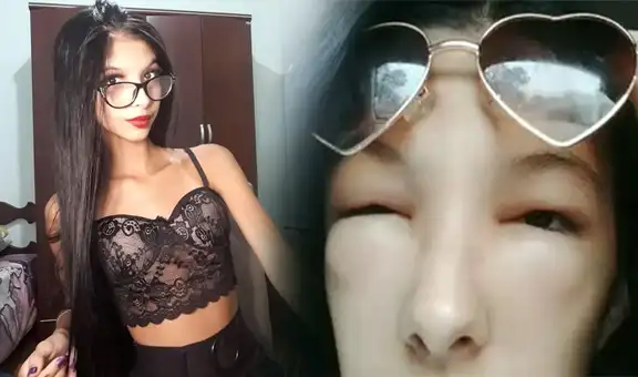 “Me sentí como un monstruo”: joven sufre fuerte reacción alérgica tras aplicarse tinte capilar
