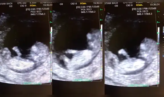 Descubren a bebé de 12 semanas ‘jugando’ en el vientre de su madre [VIDEO]