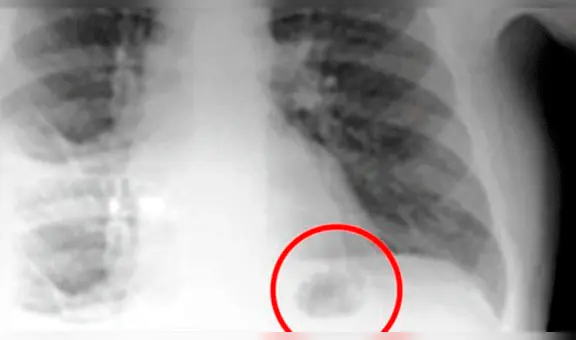 Creyó que una mancha en sus pulmones era cáncer, pero se llevó tremenda sorpresa al descubrir la verdad [FOTO]