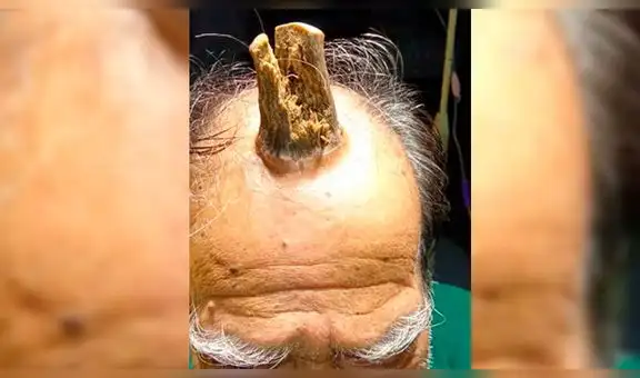 Hombre sufrió duro golpe en la cabeza y le creció un “cuerno del diablo” [FOTOS]