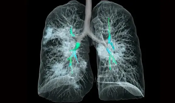 Hipoxia silenciosa: el estado en el que una persona con COVID-19 no siente que está grave