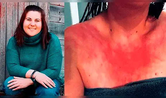 EE. UU.: mujer siente “quemaduras” al bañarse y al tomar agua debido a una extraña alergia 