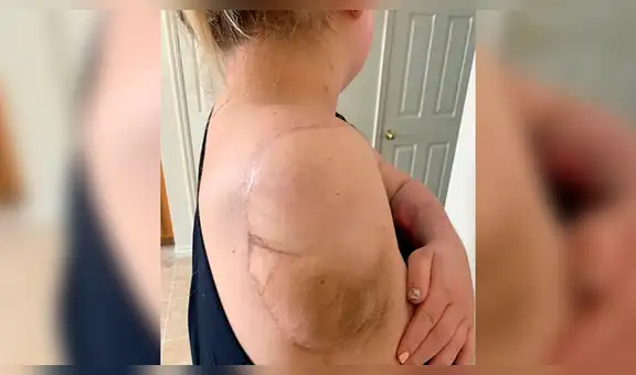 Mujer de 26 años perdió el brazo y estuvo once días en coma por una bacteria carnívora 