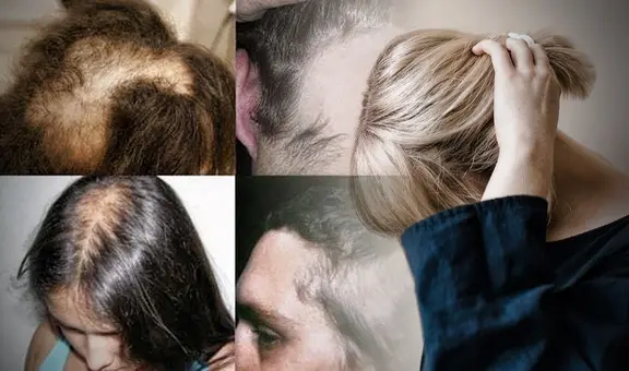 Tricotilomanía: ¿qué hay detrás del trastorno que lleva a las personas a arrancarse los cabellos? 