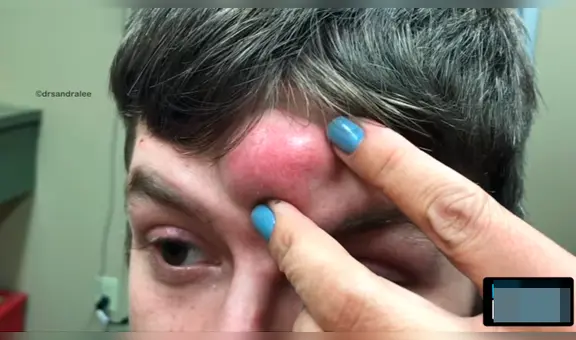 En YouTube, repugnante video de doctora que retiró espinilla gigante