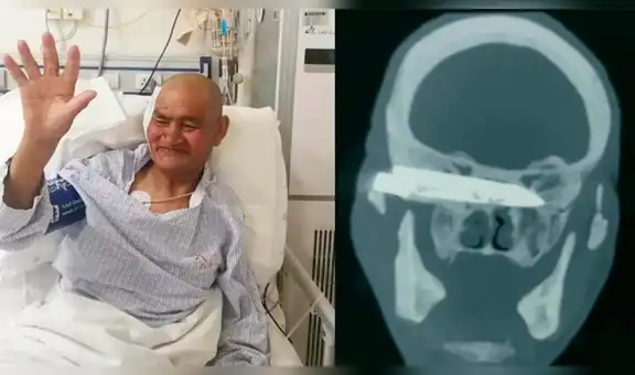 Extraen cuchillo oxidado de la cabeza de un hombre que había sido apuñalado hace 26 años