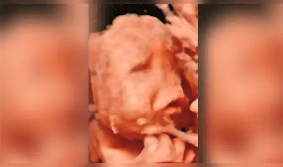 Publican primera foto de Rodrigo “el bebé sin rostro” que nació en Portugal