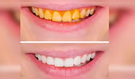 YouTube: conoce cómo blanquear tus dientes en tan solo 5 minutos [VIDEO] 