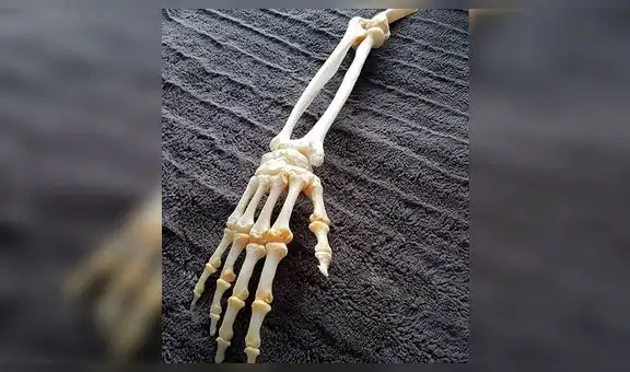 Hombre conserva los huesos disecados del brazo que le amputaron [FOTOS]