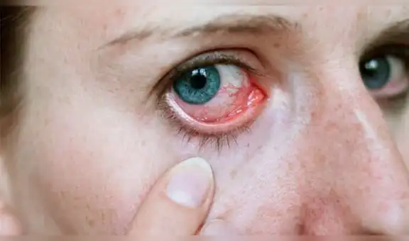Se le irrita un ojo y doctor encuentra gusanos parásitos en su interior [FOTOS] 