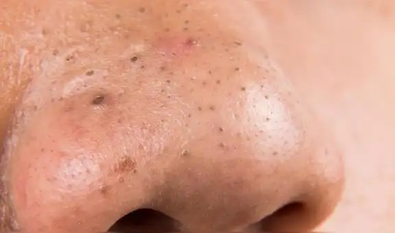 Cómo eliminar los puntos negros de la nariz de forma fácil, rápida y económica