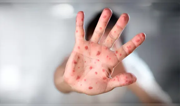 Más de 22 millones de bebés no se vacunaron contra el sarampión durante la pandemia de la Covid-19