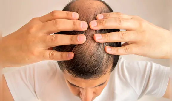 Para un tribunal laboral en Inglaterra, llamar ‘calvo’ a un hombre es acoso sexual