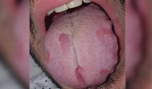 COVID-19: pacientes presentan lesiones en lengua y manchas en la piel