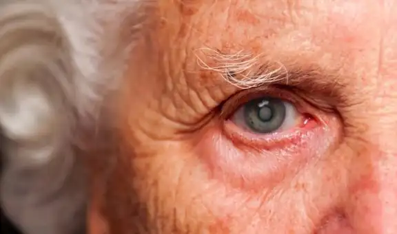 Catarata: conoce los detalles de la primera causa de ceguera reversible