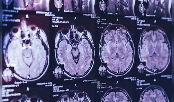 Alertan sobre misteriosa enfermedad cerebral que se propaga en Canadá